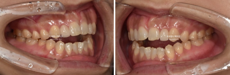 비수술 개방교합 클리피씨 30대 무삭제 라미네이트 치료기간 2년 관련 이미지 3