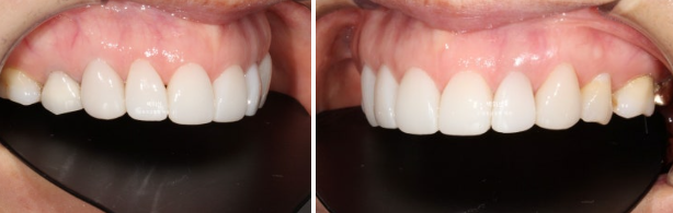 40대 무삭제 라미네이트 블랙트라이앵글 레진 치료 관련 이미지 6