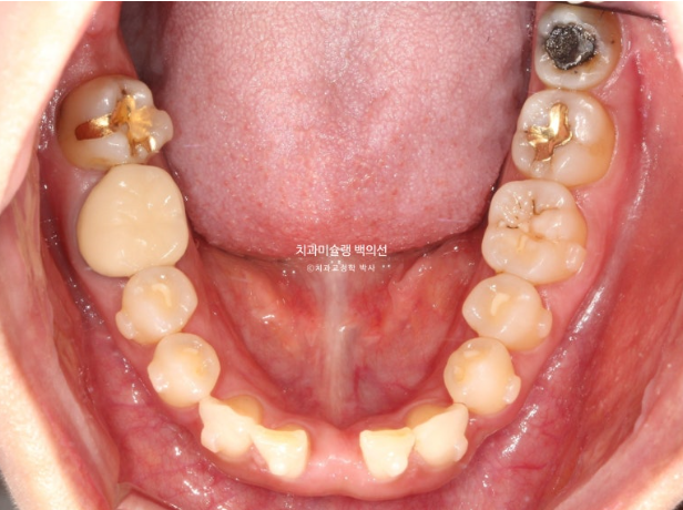해외거주 앞니 선천적 결손 과개교합 인비절라인 라이트 브릿지 치료 관련 이미지 12