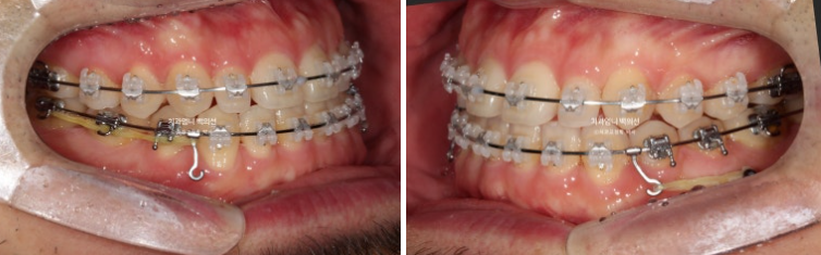 주걱턱 교정 반대교합 소구치 선천적 결손 부정교합 비발치 교정 후기 관련 이미지 8