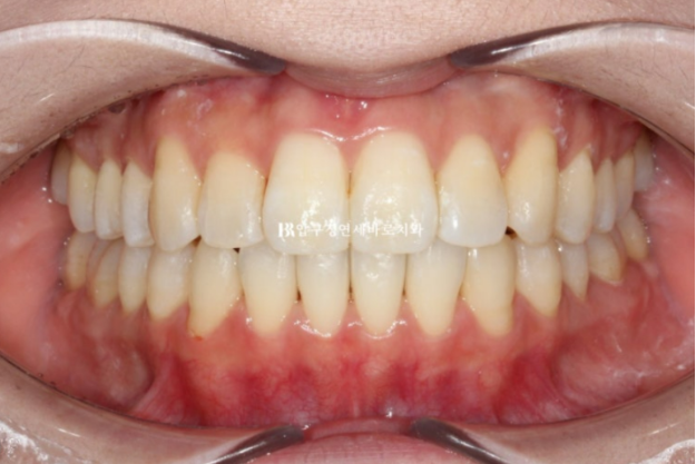 9-Month Invisalign Lite Review|Real Case Improving a Crossbite and Crooked Teeth Together image 7