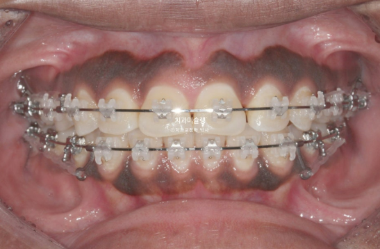 Extraction & re-orthodontics with Clippy-C, intrusion for dental implant. 관련 이미지 8