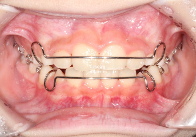 어린이 투명교정 인비절라인 퍼스트 과개교합 교정 후기 관련 이미지 13