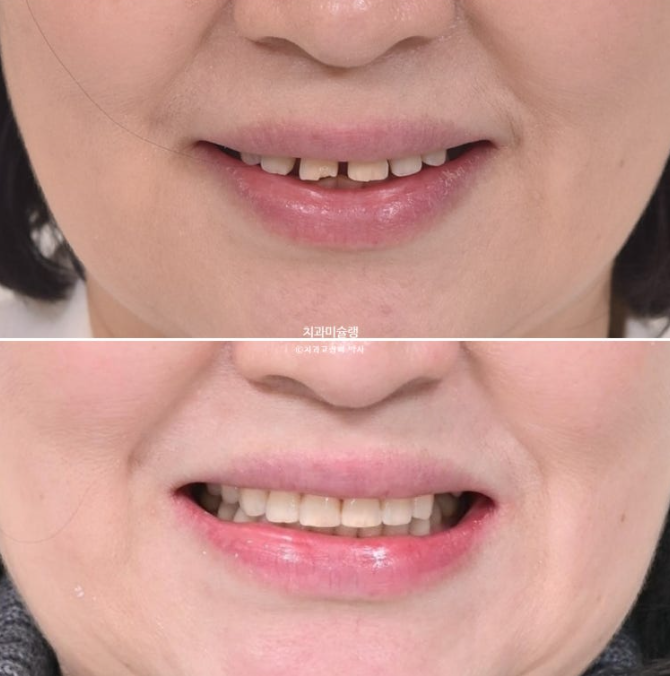 50대 치아교정 돌출 치아벌어짐 중년교정 관련 이미지 20