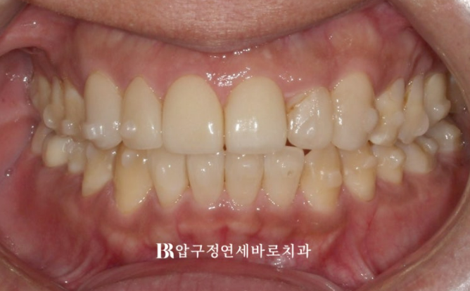 40대 치아교정 인비절라인 라이트 덧니 교정 어금니 교합 부작용 관련 이미지 8