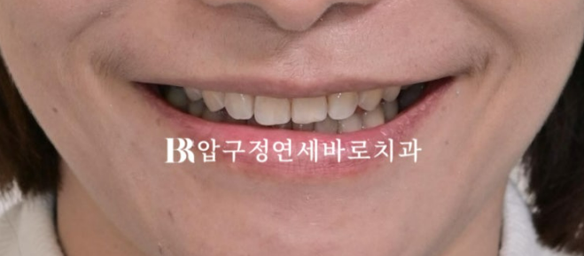 벌어진 치아 교정 인비절라인 라이트 무삭제 라미네이트 치료 관련 이미지 16