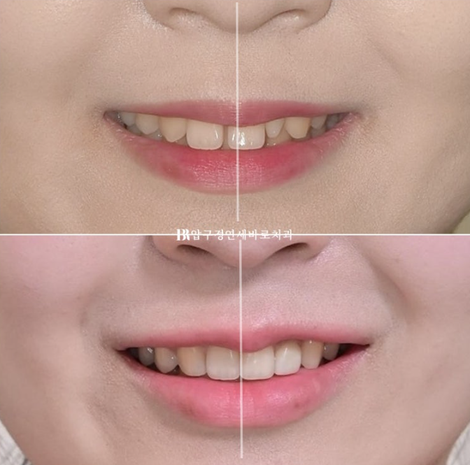 Actual Case of Treating Congenitally Missing and Peg-Shaped Teeth Without Implants image 17