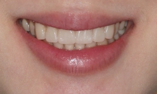 Non-Prep Veneer Review | A Case Naturally Improving Gaps Between the Front Teeth and the Smile Line image 8