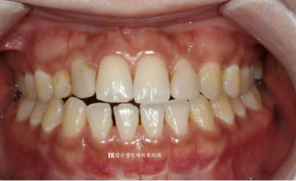 왜소치 치료 잔존유치 무삭제 라미네이트 후기 관련 이미지 3