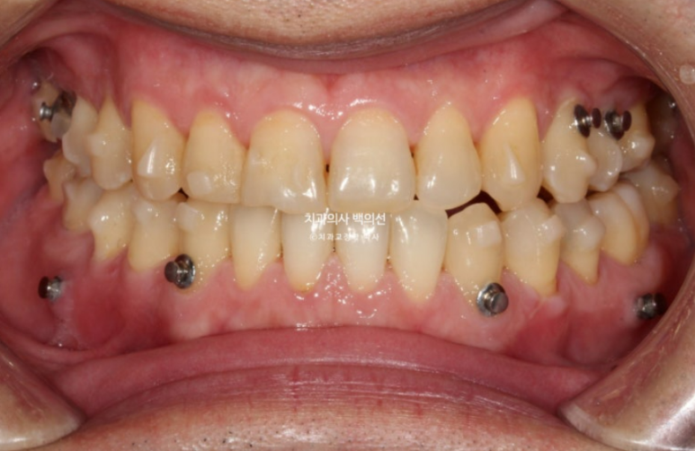 40대 인비절라인 비수술 비발치 주걱턱 비대칭 교정 관련 이미지 7