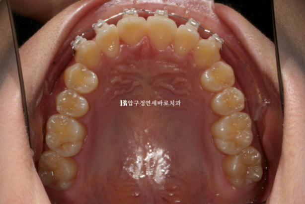 강남 교정치과 덧니 앞니 부분교정 후기|6개월 만에 배열과 절단교합까지 개선한 단기교정 관련 이미지 5