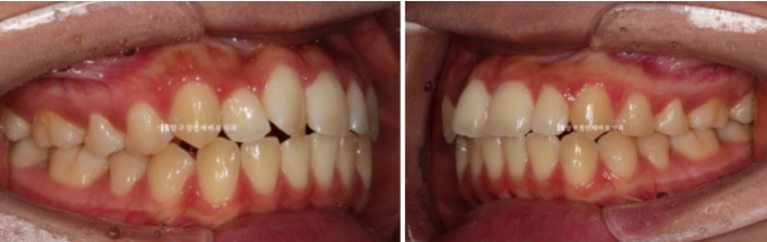 압구정 교정치과 덧니 부분교정 단기교정 후기 관련 이미지 4