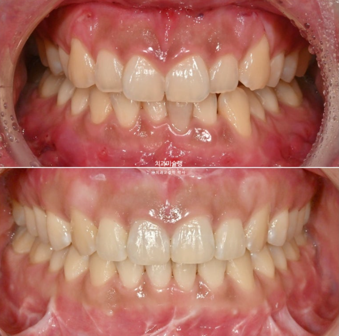 선수술 양악수술 비대칭 주걱턱 잇몸미소 치료 인비절라인 라이트 관련 이미지 17