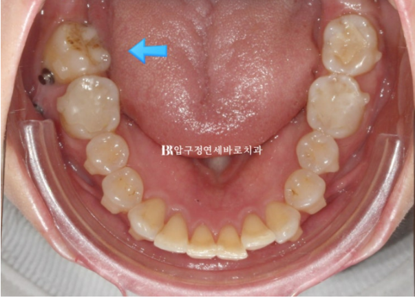 40대 발치교정 대신 인비절라인 라이트? 10개월 치료로 어디까지 가능할까요? 관련 이미지 10