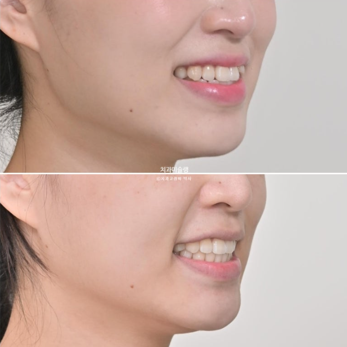 인비절라인 라이트 반대교합? 덧니 중심선 치간삭제 치료 관련 이미지 19