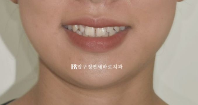 인비절라인 + 무삭제 라미네이트로 왜소치 치료하기 관련 이미지 2