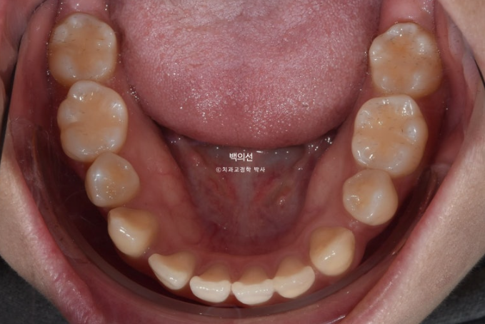 돌출입 교정 인비절라인 발치 교정 개방교합 치료 후기 관련 이미지 7