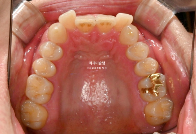 덧니 앞니 부분교정 급속교정 단기 MTA 미니튜브 기간 6개월 관련 이미지 4