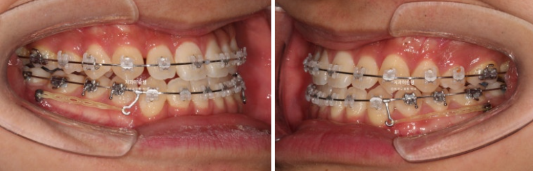 비수술 비발치 주걱턱 절충치료 클리피씨 개방교합 반대교합 치료 관련 이미지 7