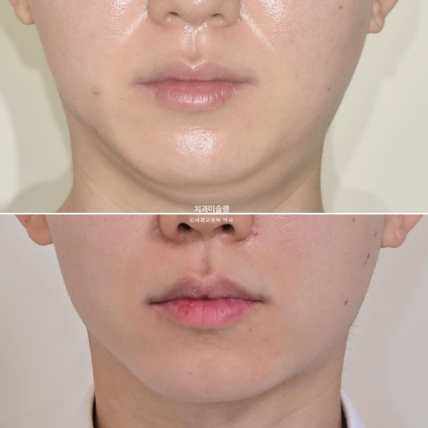 비대칭 비발치 거미스마일 잇몸미소 중심선 가위교합치료 무삭제 라미네이트 관련 이미지 27