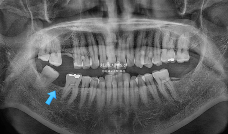 40대 인비절라인 라이트 과개교합 과잉치 덧니 교정 임플란트 보철 교정 후기 관련 이미지 7