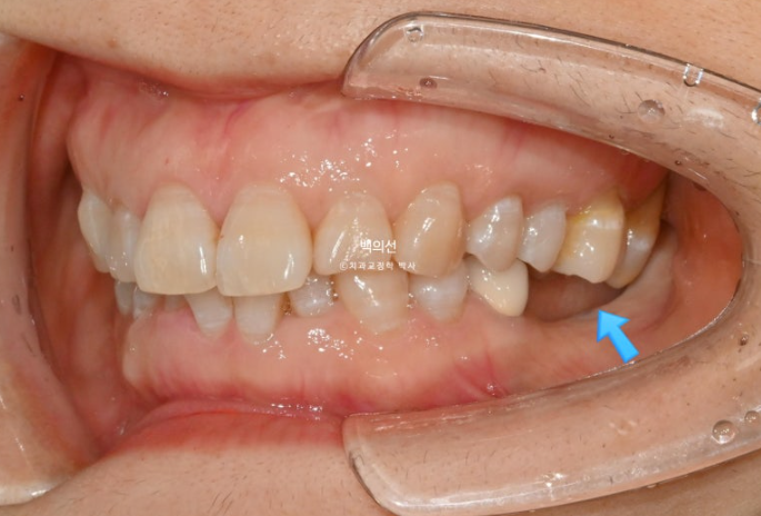 40대 인비절라인 라이트 앞니 돌출 과개교합 덧니 교정 후기 관련 이미지 3