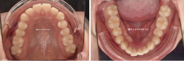 돌출입 교정 치아 벌어짐 인비절라인 투명교정 치료 관련 이미지 4