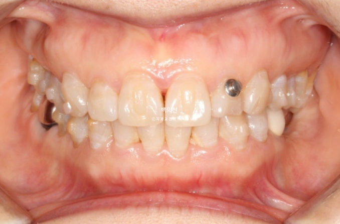 40대 인비절라인 라이트 앞니 돌출 과개교합 덧니 교정 후기 관련 이미지 8