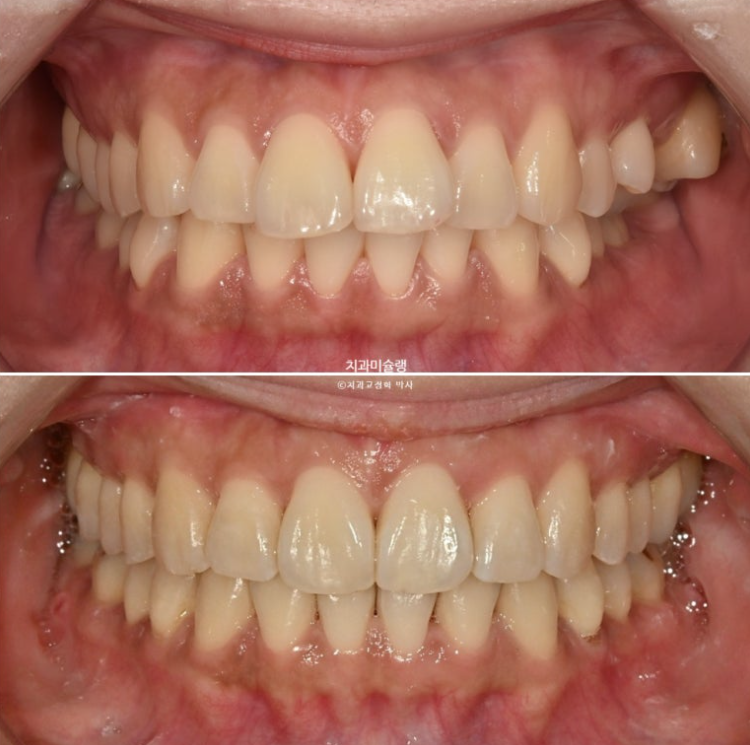 비발치 돌출입 인비절라인 교정 가위교합 중심선 맞추기 관련 이미지 22