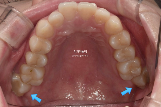 심한 돌출입 입술부전증 호두주름 발치교정 치료 관련 이미지 4