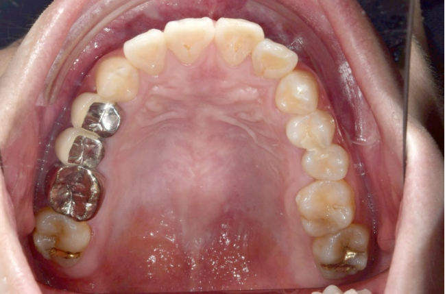돌출입 발치 교정 인비절라인 후기 미니스크류 관련 이미지 4