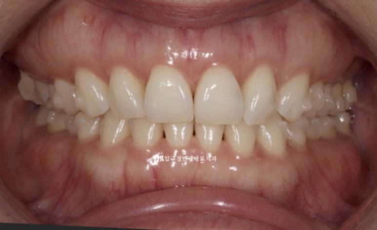 인비절라인 라이트 가위교합 치아 벌어짐 치료 관련 이미지 6