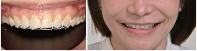 Can Gaps Between the Front Teeth Be Treated with No-Prep Veneers Alone? A Real Case Completed with Gelami After Invisalign Lite image 17