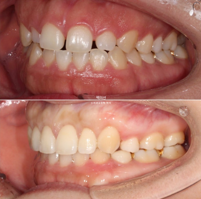 30대 치아교정 돌출입 교정 :: 잇몸미소 거미스마일 교정 입술부전증 결손치 무턱교정 관련 이미지 20