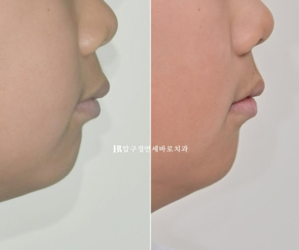 어린이 무턱교정 인비절라인 퍼스트 실제 치료 후기 관련 이미지 24