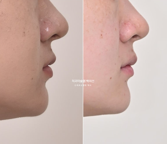 앞니 벌어짐 합죽이 방지 교정 기간 1년 4개월 관련 이미지 17