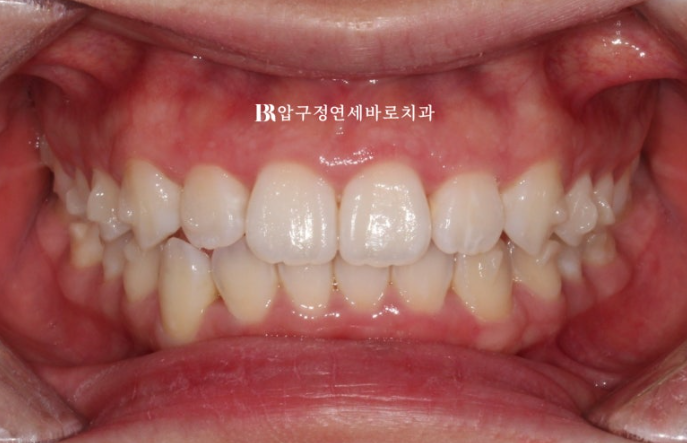 인비절라인 라이트 과개교합 반대교합 돌출입 뻐드렁니 교정 치료 관련 이미지 8