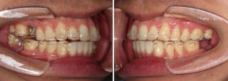 40대 인비절라인 라이트 과개교합 과잉치 덧니 교정 임플란트 보철 교정 후기 관련 이미지 10
