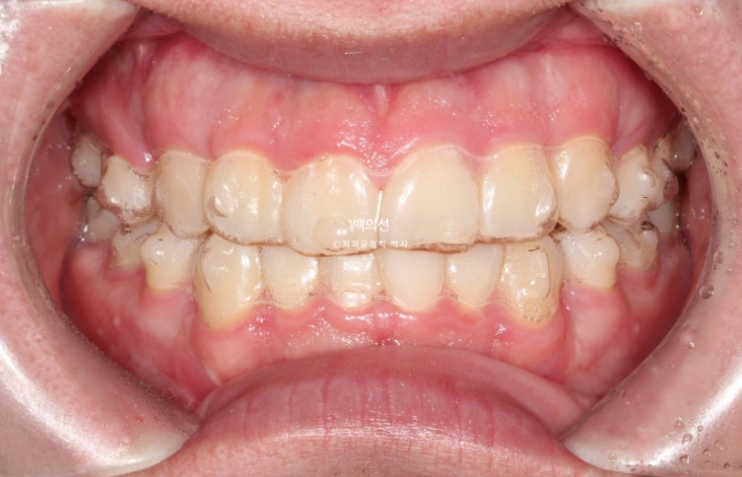 돌출입 수술 ASO + 인비절라인 라이트 후교정 치료기간 10개월 관련 이미지 7