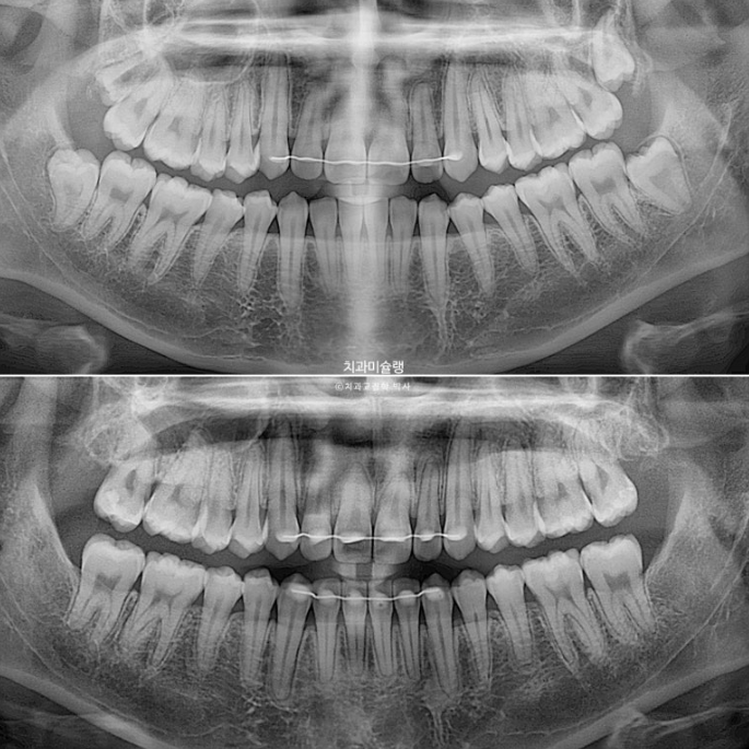 비발치 비수술 주걱턱 반대교합 재교정 치료 관련 이미지 20