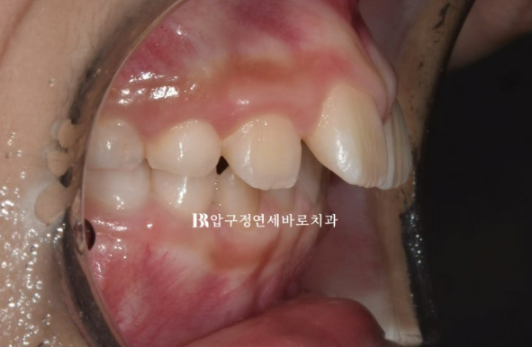어린이 무턱 성장교정, 인비절라인 퍼스트 MA로 치료한 골격성 II급 부정교합 증례 관련 이미지 3