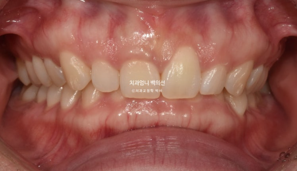 옥니 거미스마일 과개교합 교정, 잇몸돌출까지 개선한 비발치 클리피씨 교정 증례 관련 이미지 2