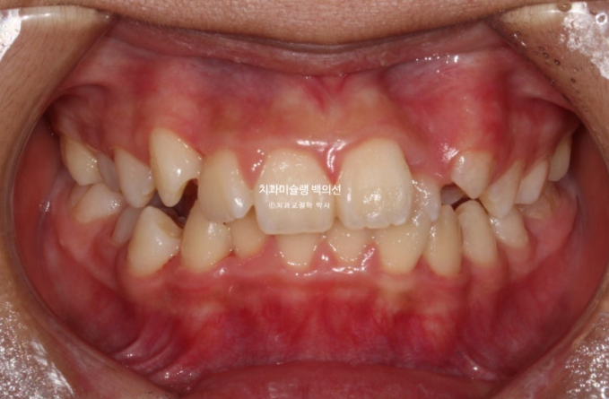 덧니 반대교합 과개교합 인비절라인 퍼스트 악궁확장 어린이 교정 치료 관련 이미지 2
