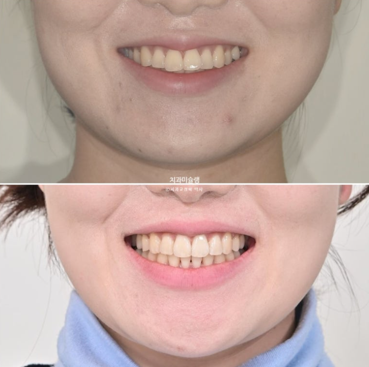 비발치 돌출입 인비절라인 교정 가위교합 중심선 맞추기 관련 이미지 24