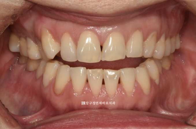50대 인비절라인 개방교합 합입교정 미니스크류 관련 이미지 2