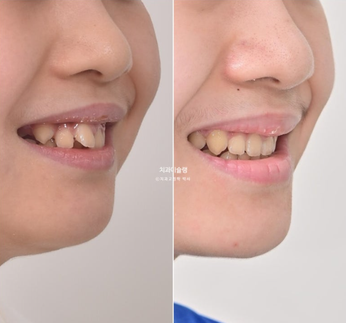 선천적 결손 잔존유치 과개교합 돌출입 인비절라인 퍼스트 어린이 투명교정 치료기간 관련 이미지 1