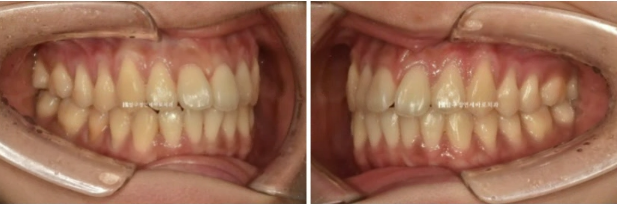 인비절라인 익스프레스 토끼이빨 앞니교정 ? 관련 이미지 4