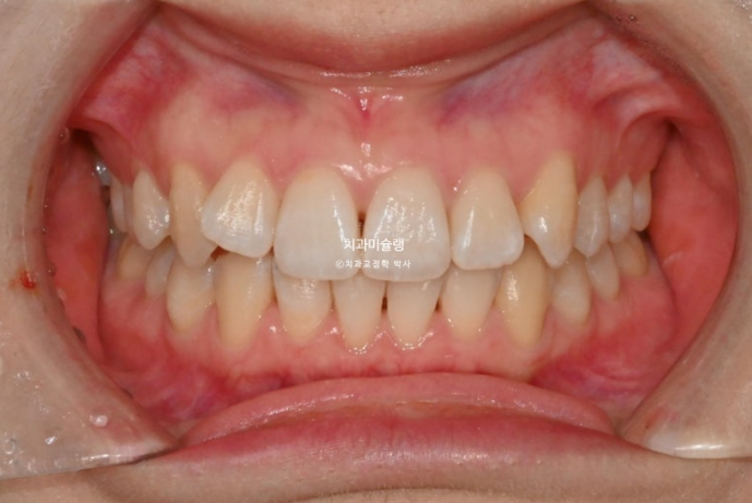 덧니 인비절라인 라이트 잇몸미소 거미스마일 중심선 블랙트라이앵글 관련 이미지 2