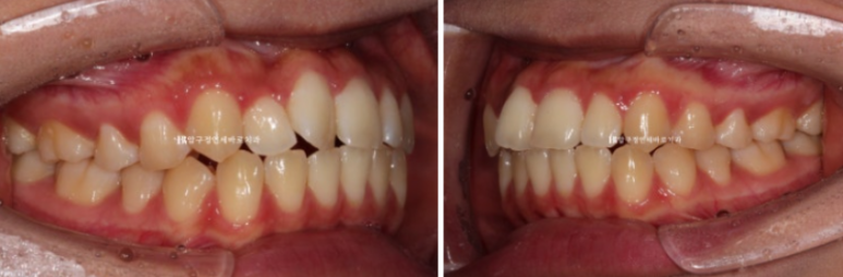 덧니교정 앞니부분교정 치간삭제 후기 관련 이미지 4