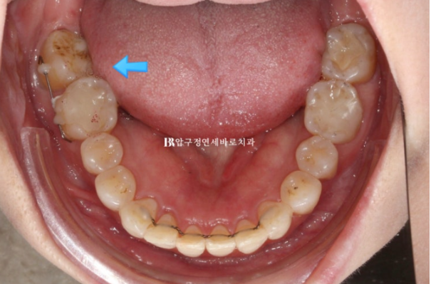 40대 인비절라인 라이트 가위교합? 관련 이미지 12